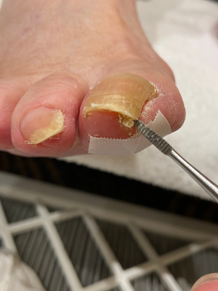 高齢者様の爪切りも！ 埼玉県で巻き爪・陥入爪にお悩みならリペディア RePedia