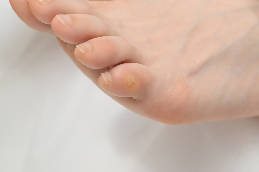 小指のタコ