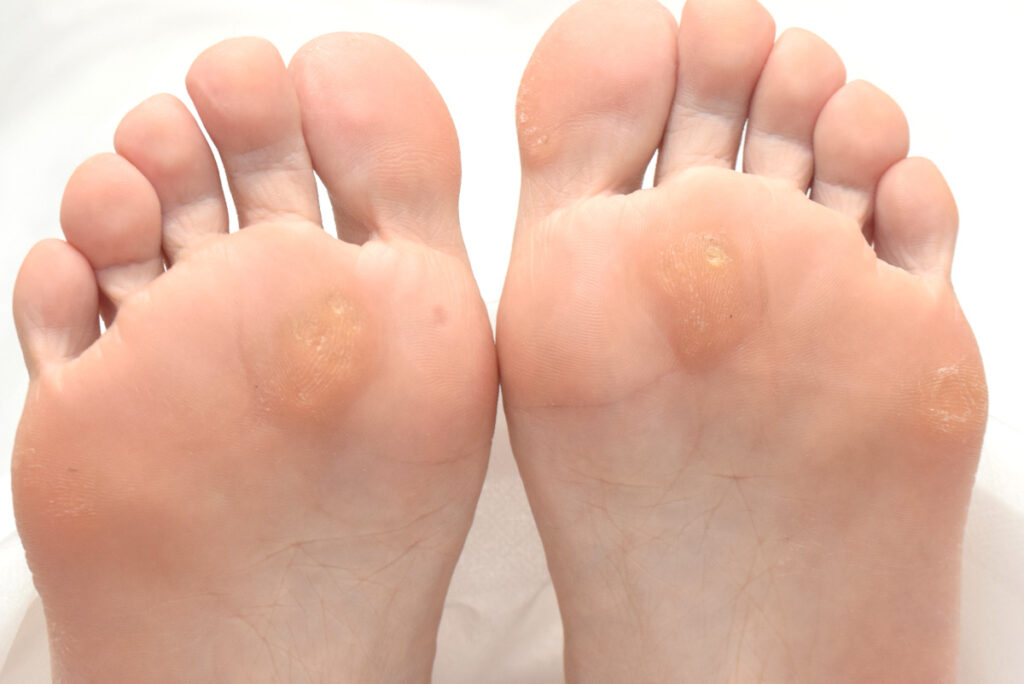 魚の目やタコがいっぱいある？